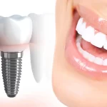 Smile Brighter, Pay Less: Exploring the Benefits of Dental Implants in Turkey